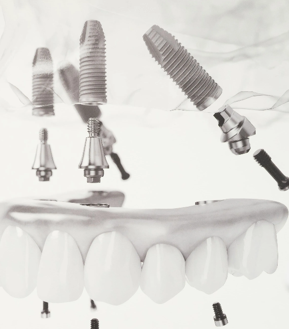 Implantes dentales sobre una arcada de dientes naturales.